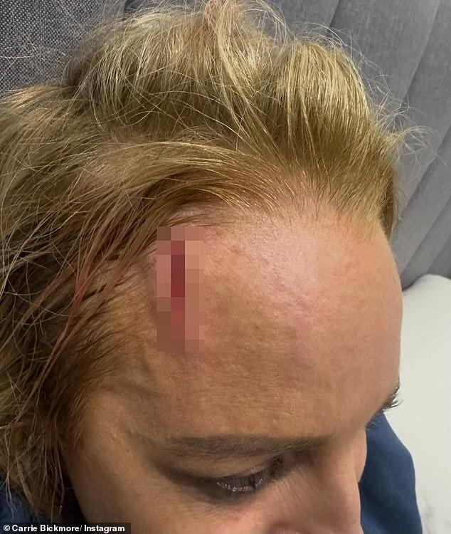 News Room : Carrie Bickmore reveals grisly head wound as