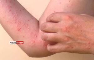News Room : Chikungunya Alert: Health Officials Warn of Chikungunya Threat in Densely Populated Areas