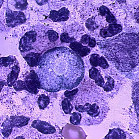 News Room : Battling a rare brain-eating disease in an